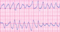 Heart rate - arhythmia